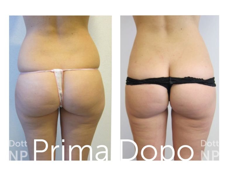 Liposuzione e Liposcultura